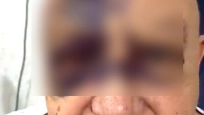 VIDEO: Luis de Alba ‘El Pirruris’ queda irreconocible del rostro tras accidente