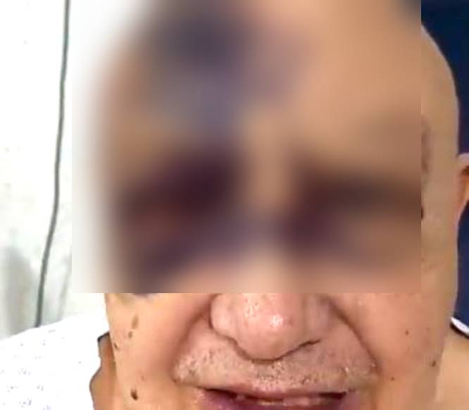 VIDEO: Luis de Alba ‘El Pirruris’ queda irreconocible del rostro tras accidente